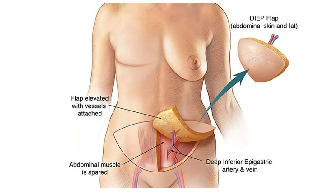 DIEP flap breast reconstruction, highlighting benefits of natural tissue use and long-term advantages.