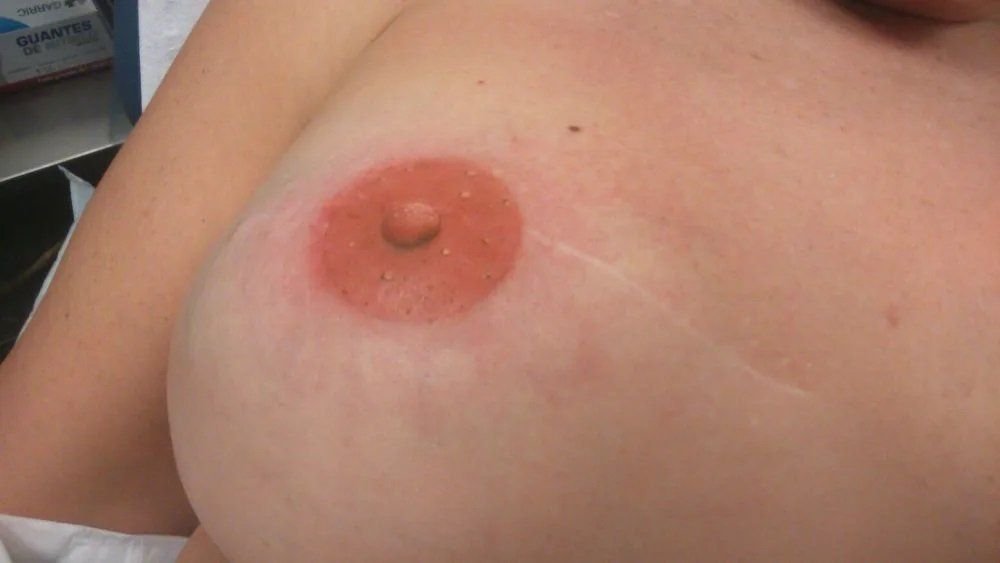 Nipple Reconstruction and 3D Nipple Tattoos | Breast Reconstruction Associates