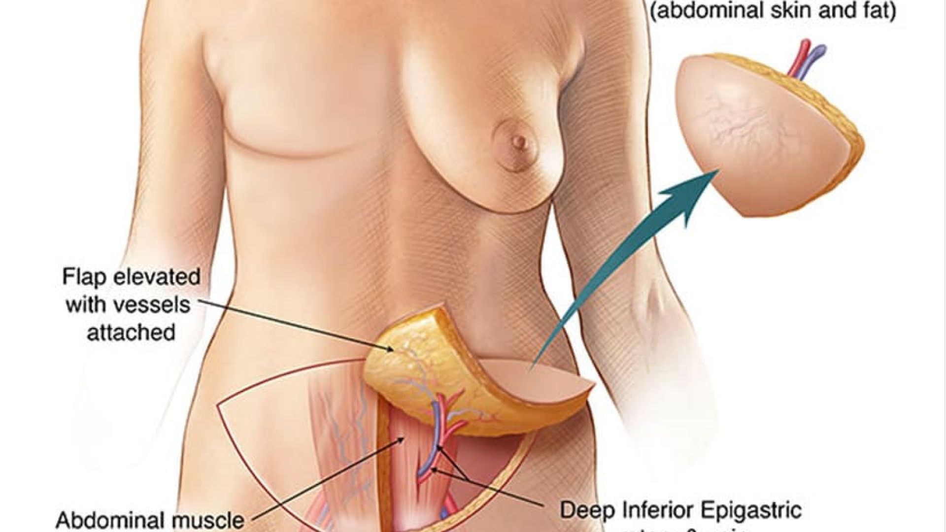Graphic of the DIEP flag reconstruction procedure