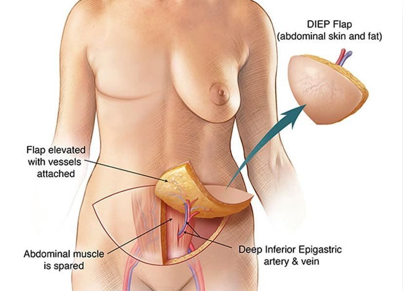 DIEP Flap vs. Implant Breast Reconstruction | Restoring What Cancer Takes Away