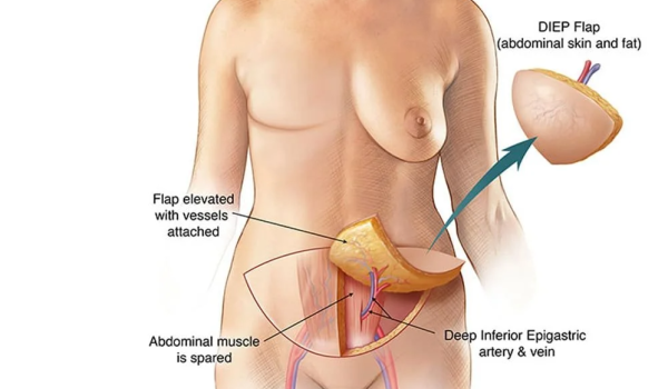 DIEP flap breast reconstruction, highlighting benefits of natural tissue use and long-term advantages.