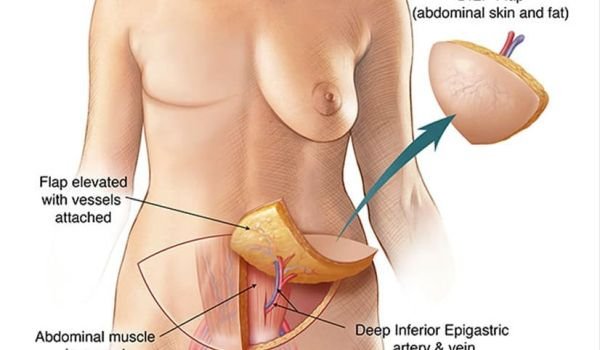 DIEP Flap vs. Implant Breast Reconstruction | Restoring What Cancer Takes Away